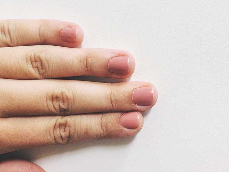 Nail Psoriasis vs. Fungus: Learn the Signs