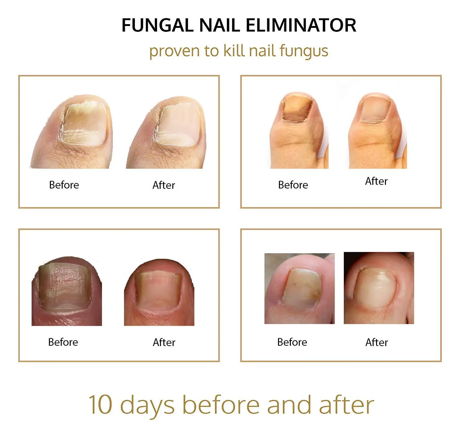 Nail &  Toenail Fungus Treatment  Fungal Nail Eliminator with ...