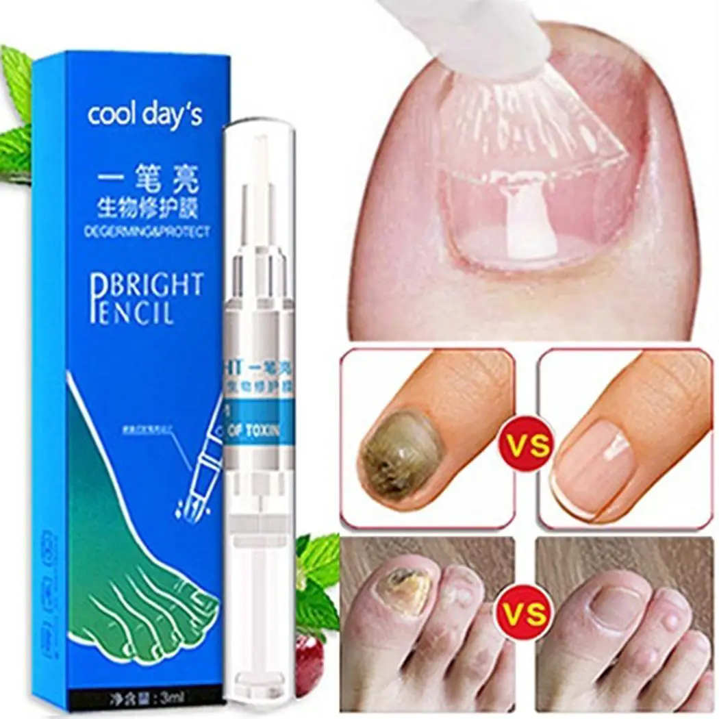 Nail Treatment Pen for Remove Nail Fungus Natural Nail The bottle is ...