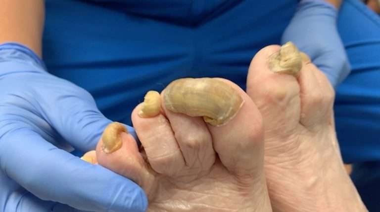NAILED IT! DOCTOR TACKLES HUGE OVERGROWN NAIL AND FUNGAL INFECTION IN ...