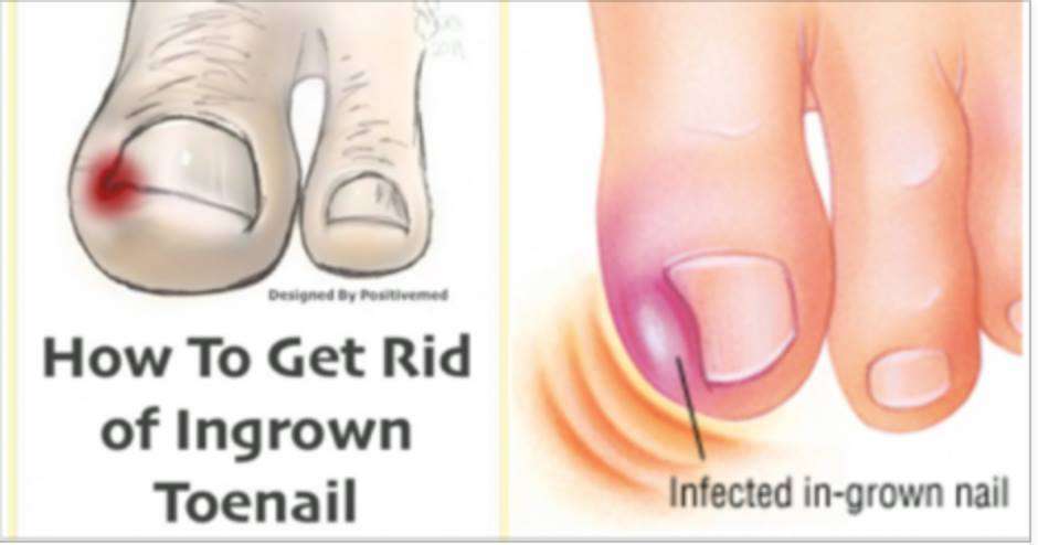 Natural Home Remedy for Ingrown Toenails