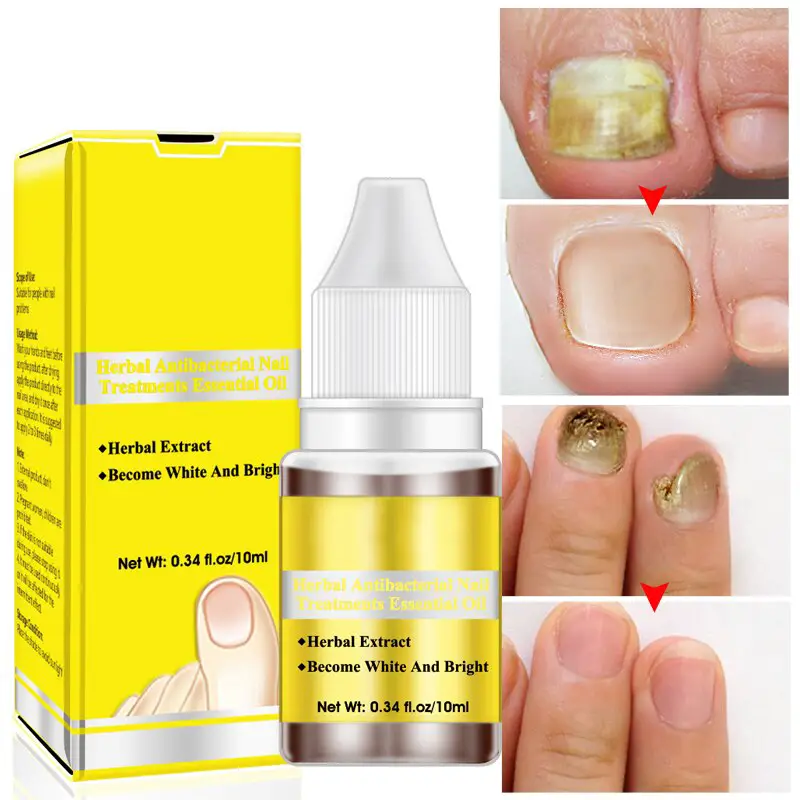 New Fungal Nail Treatment Essence Foot Whitening Oil Effective Removal ...