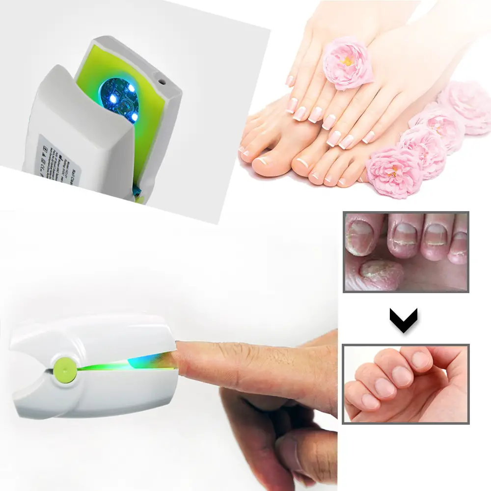 NEW Home Use Toe Nail Fungus Laser Therapy Treatment Device ...