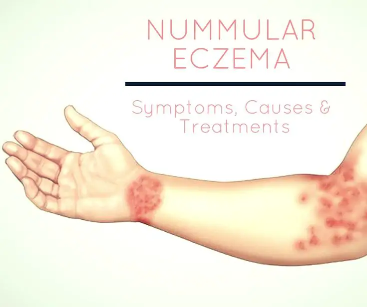 Nummular Dermatitis Eczema Diagnosis &  Treatments