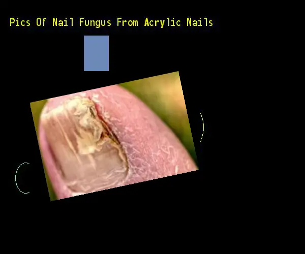 Pics of nail fungus from acrylic nails