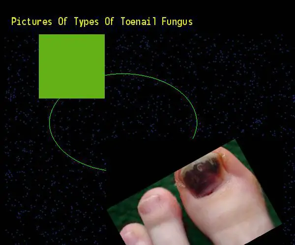 Pictures of types of toenail fungus