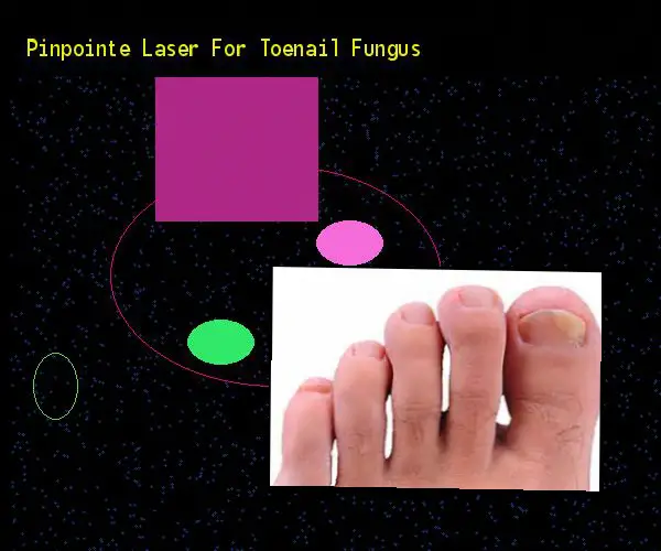 Pinpointe laser for toenail fungus