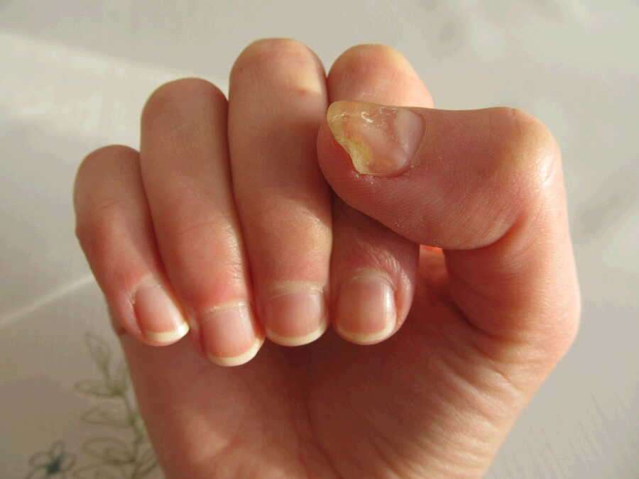 Psoriasis or nail fungal infection? How to tell