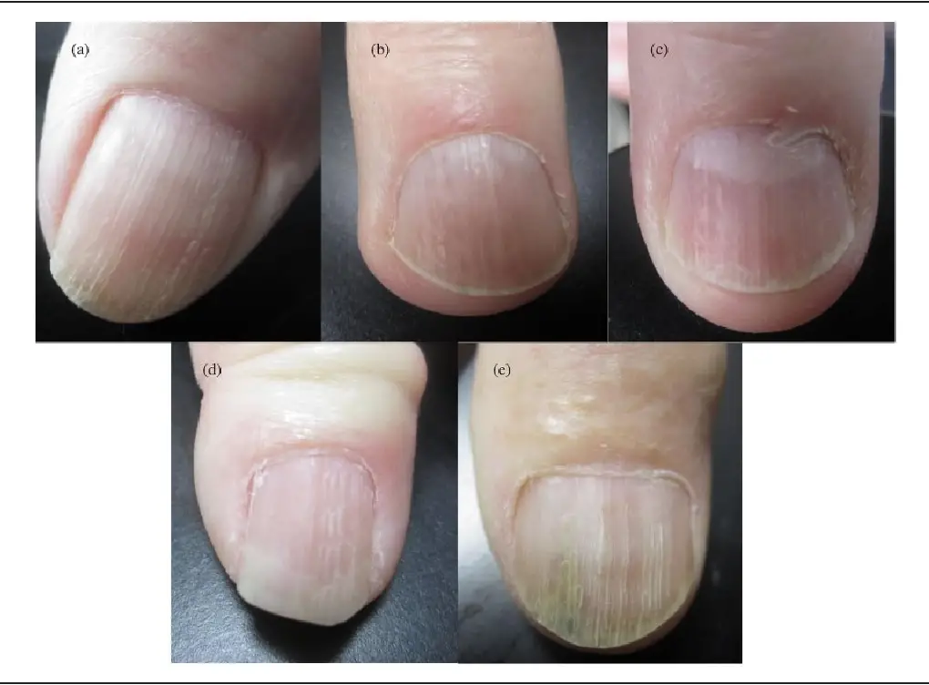 Psoriatic Nail Changes Are Associated With Clinical Outcomes in ...