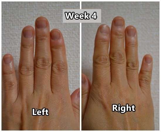 Quit Biting Nails Week 4 (Month1)   Nail biting treatment ...