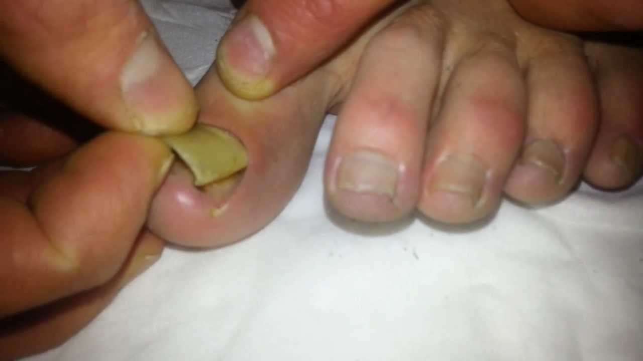 Removal of Dead toenail!!!