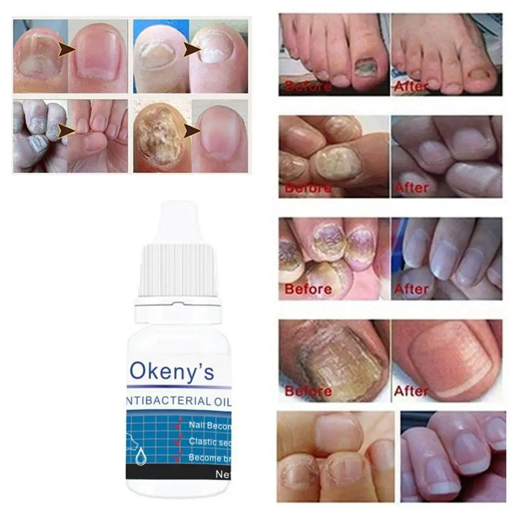 Removal Onychomycosis Toe Nail Fungus Repair Anti Fungal Nail Treatment ...