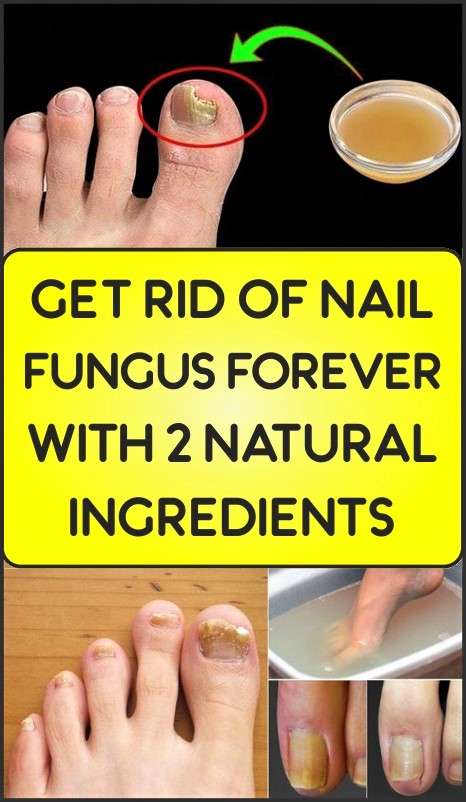 Remove Nail Fungus Forever With 2 Natural Ingredients