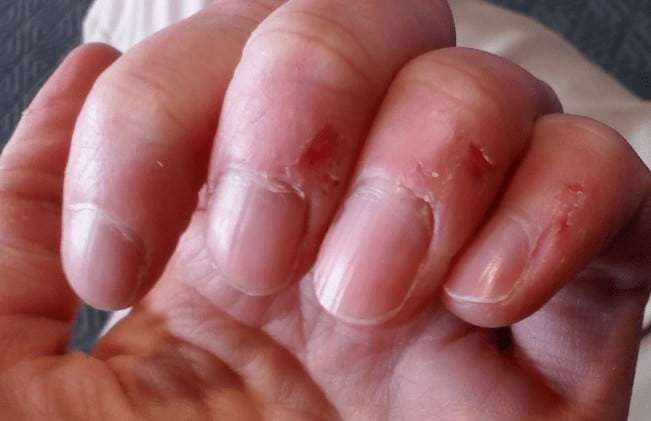 Skin Peeling on Fingers Near Nails: Causes and Remedies