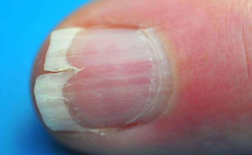 Split Fingernails (Onychoschizia): Symptoms, Causes ...