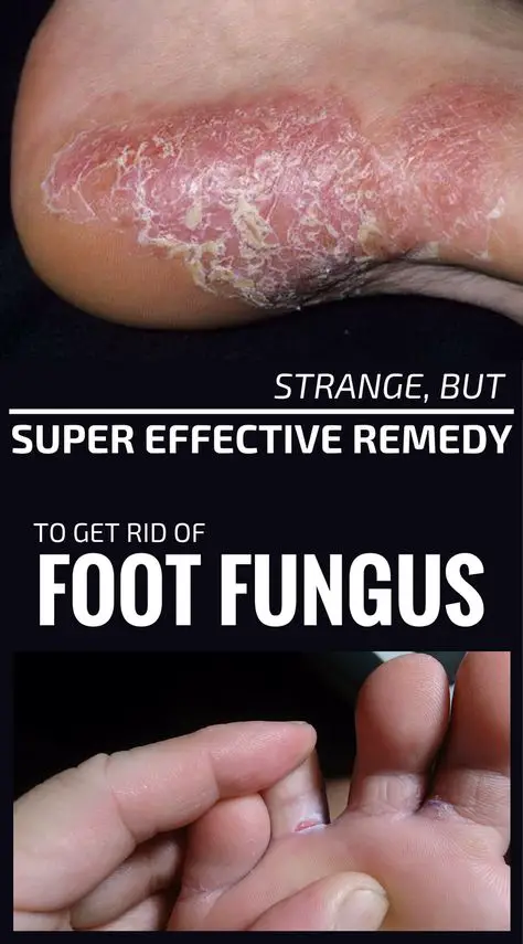 Strange, But Super Effective Remedy To Get Rid Of Foot Fungus