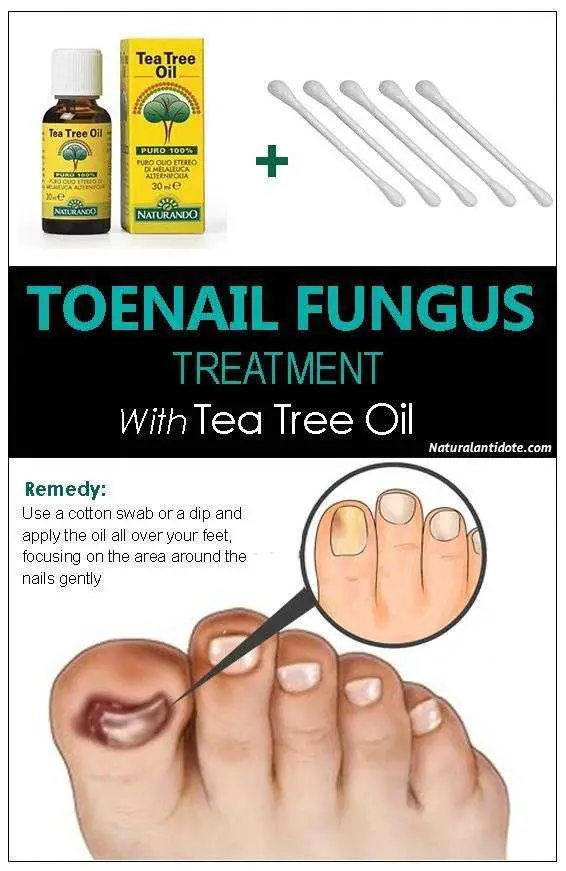 Tea tree oil for toenail fungus