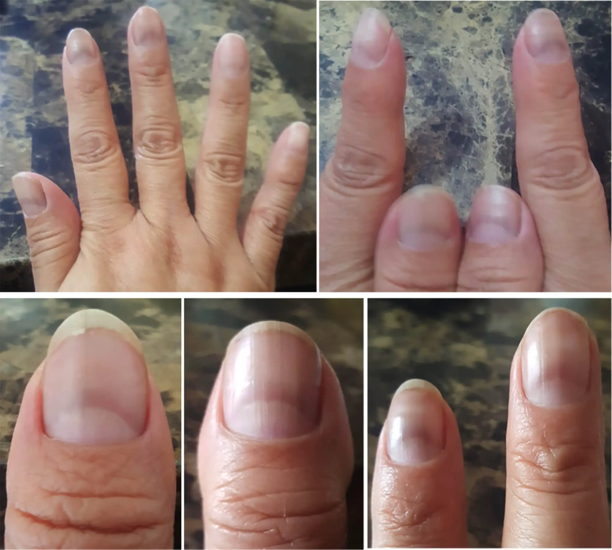 The 5 ways your nails may reveal if youve had COVID