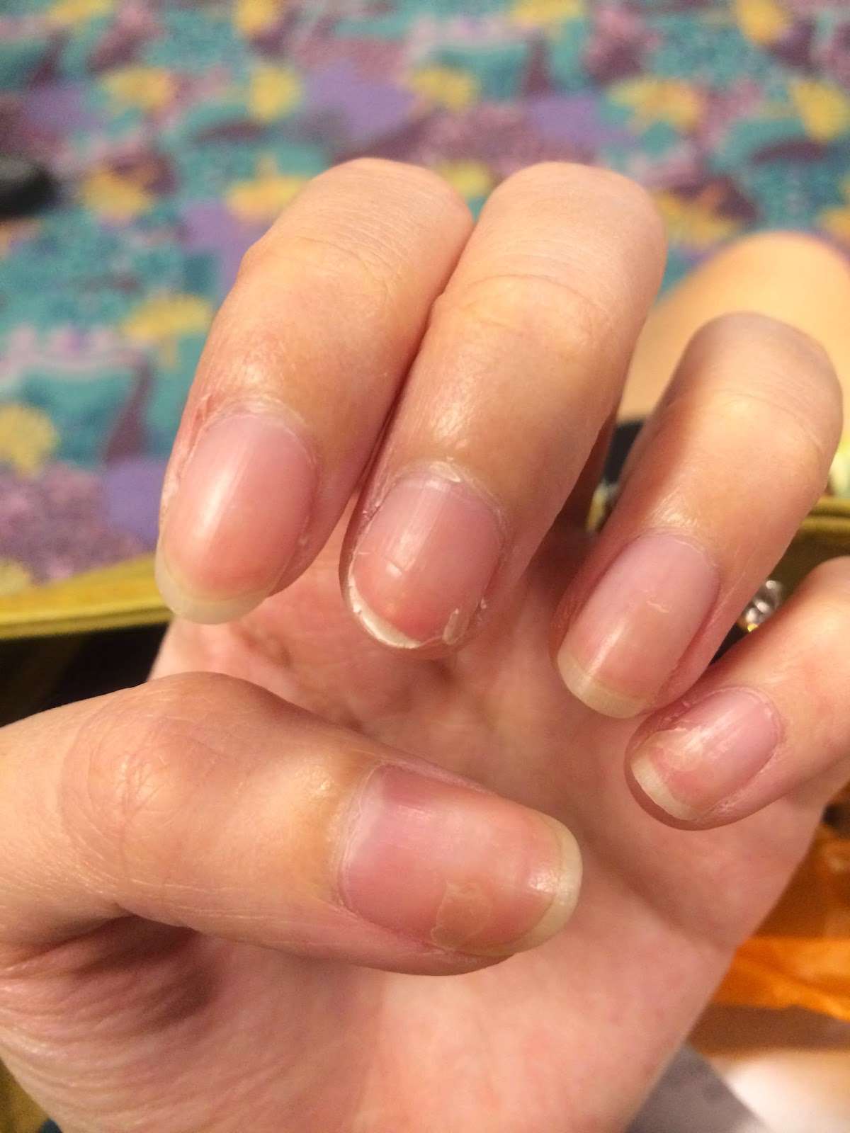 The Dettol Diaries: Peeling Fingernails after HFMD