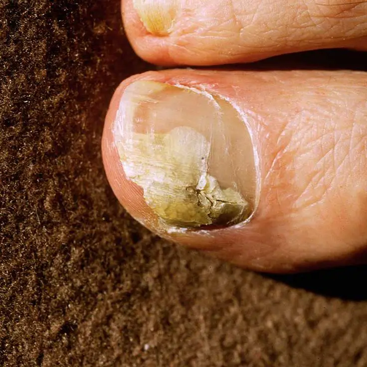 The Only Treatments Worth Trying to Get Rid of Gross Toenail Fungus ...