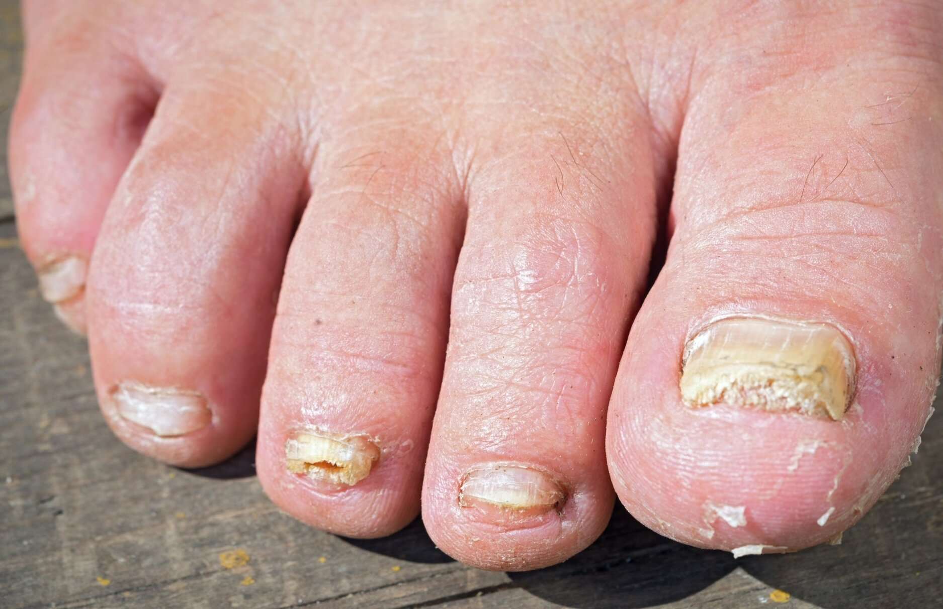 The Truth About Toenail Fungus Remedies  Worry Free Pedi