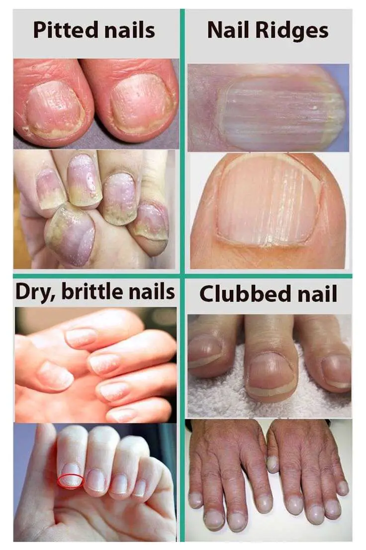 This Is What Your Fingernails Are Warning You About: Organ ...