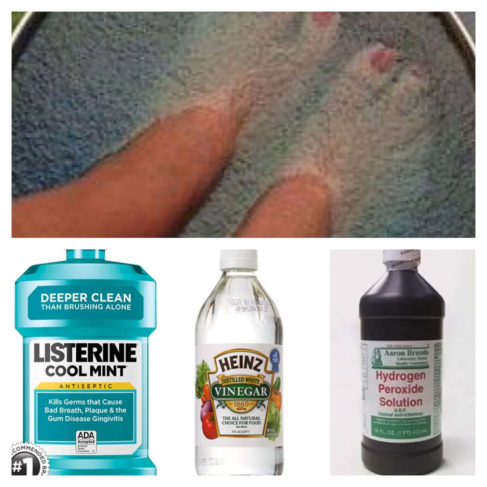 To Kill Toe Nail and Foot Fungus. 1/4 cup of each, listerine, vinegar ...