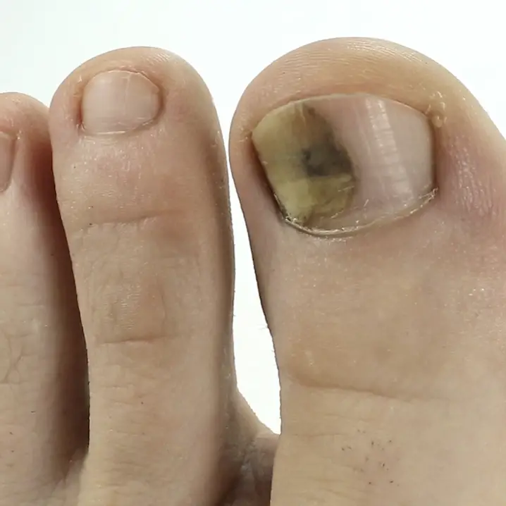 Toe Looks Bruised Under Nail