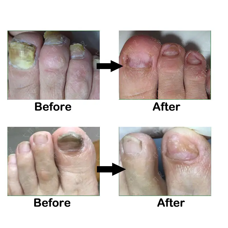 Toe Nail Fungus Removal Oil Fungal Nail Treatment Feet Care Essence ...