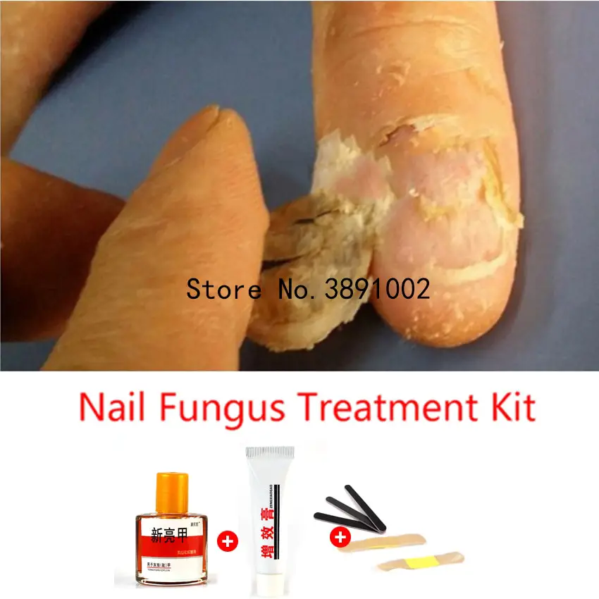 Toe Nail Fungus Treatment Anti Fungal Nail Infection Yellow Essence ...