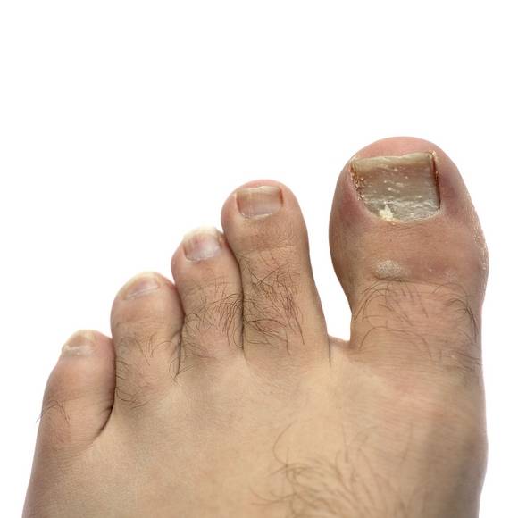 Toenail fungus has many remedies, but is hard to cure