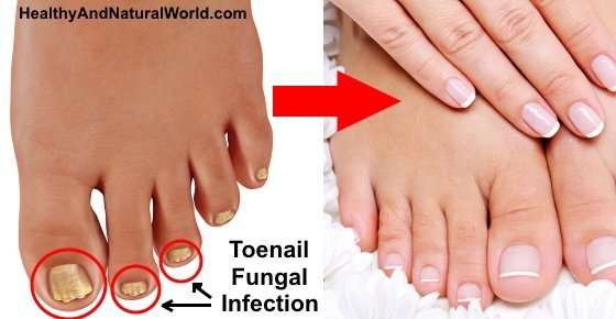 Toenail Fungus: Simple Natural Remedies to Cure It