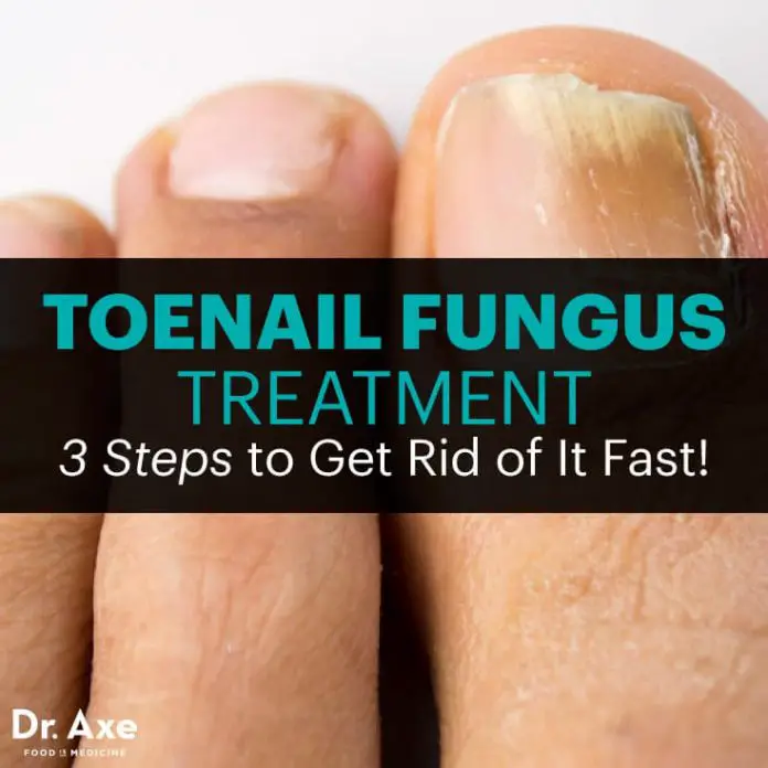 Toenail Fungus Treatment: 3 Steps to Get Rid of It Fast!