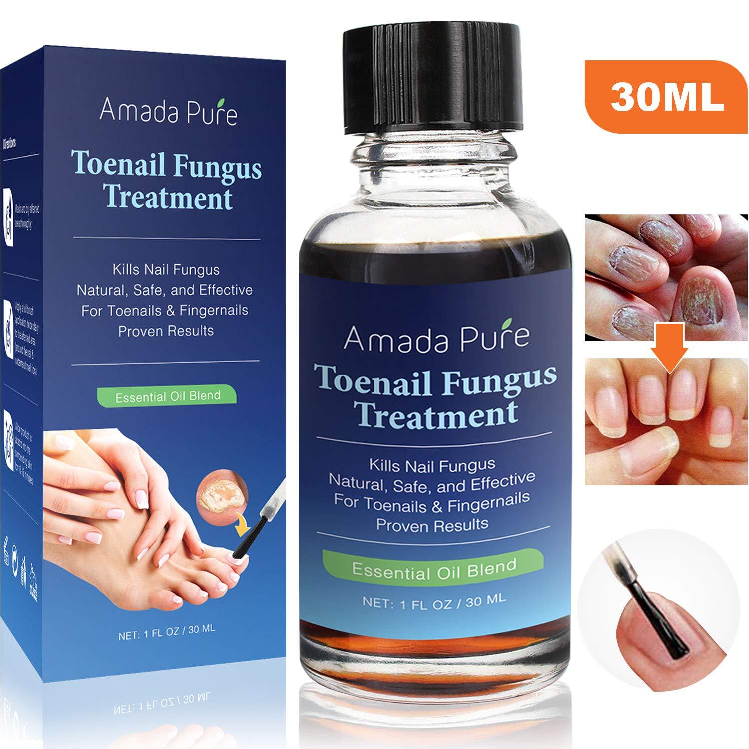 Toenail Fungus Treatment, Nail Fungus Treatment, Fungus Stop ...