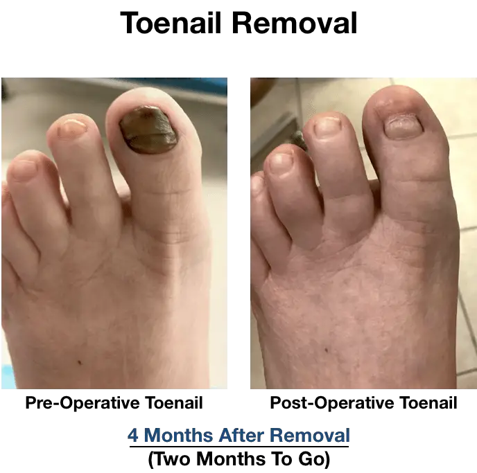 Toenail Removal Pictures