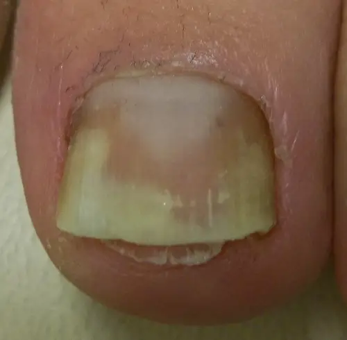 toenails lifting off nail bed