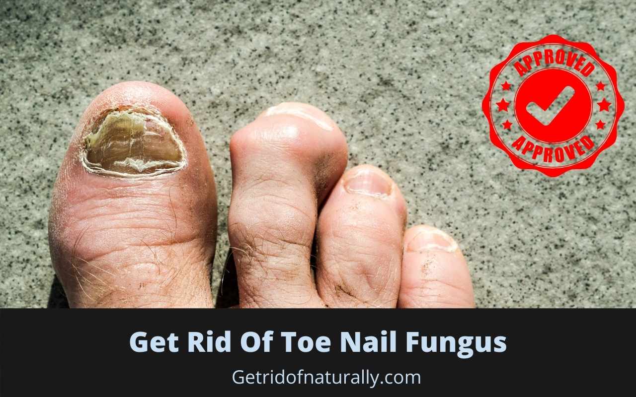 Top 7 Natural Ways to Get Rid of Toe Nail Fungus Naturally ...