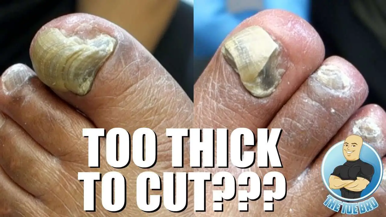 TRIMMING EXTREMELY THICK TOENAILS
