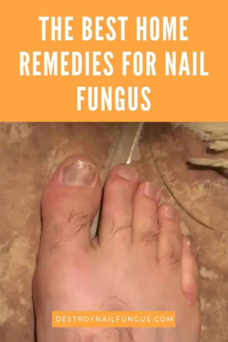 Try using of these home remedies to get rid of your nail ...