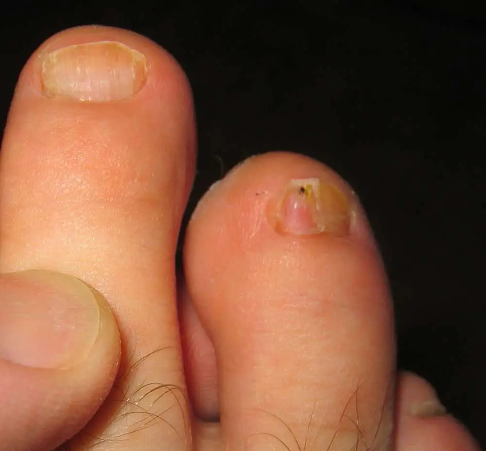 Types of toenail fungus