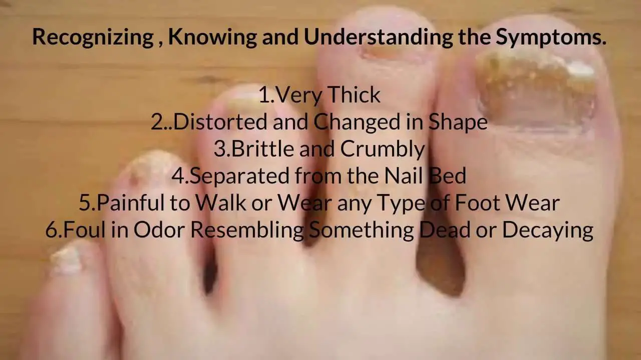 Understanding the Symptoms: How do I know I have Toenail ...