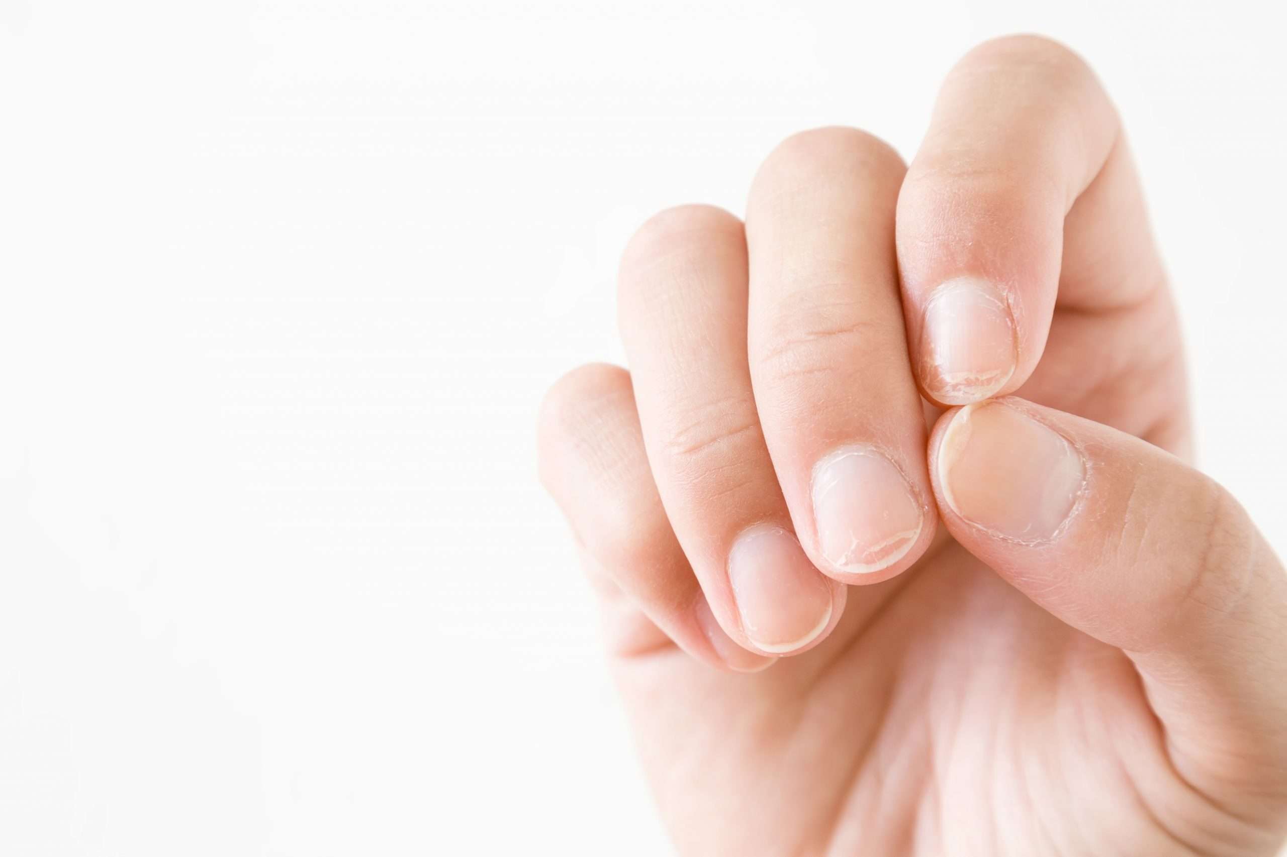 What Can You Do About Brittle Nails?