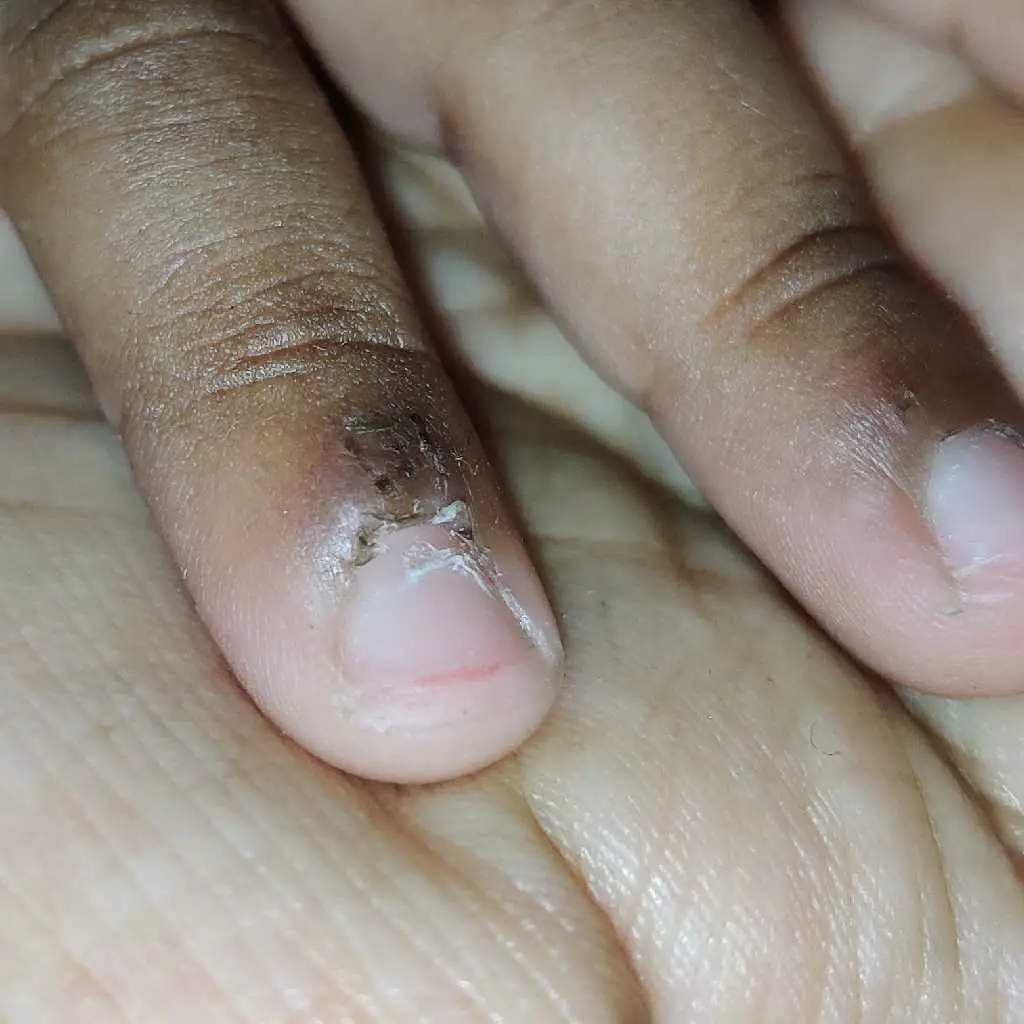 what causes peeling of skin in fingers in children?  FirstCry Parenting
