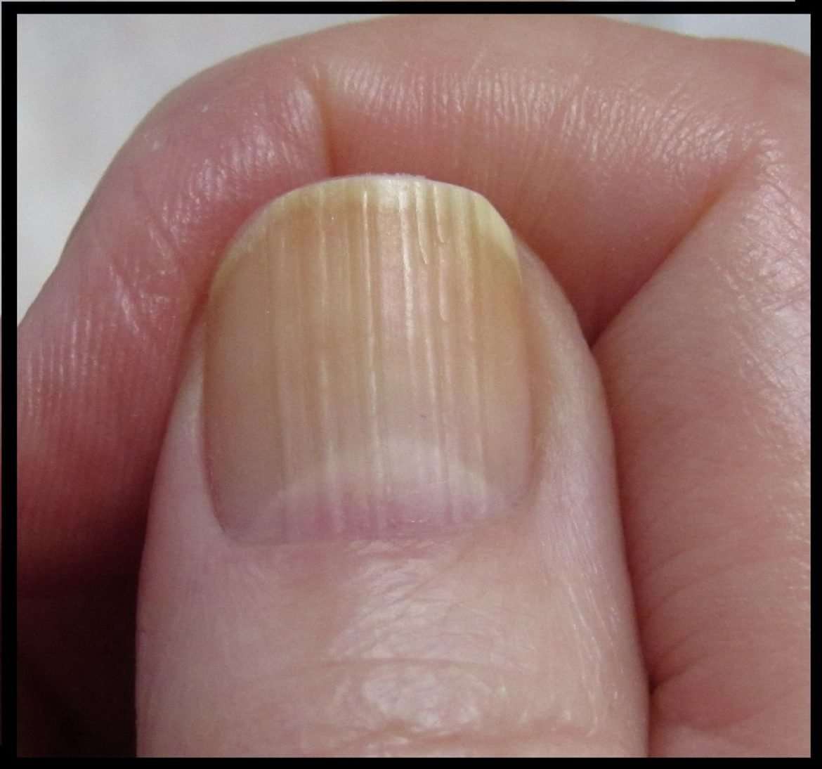 What do horizontal ridges on fingernails mean