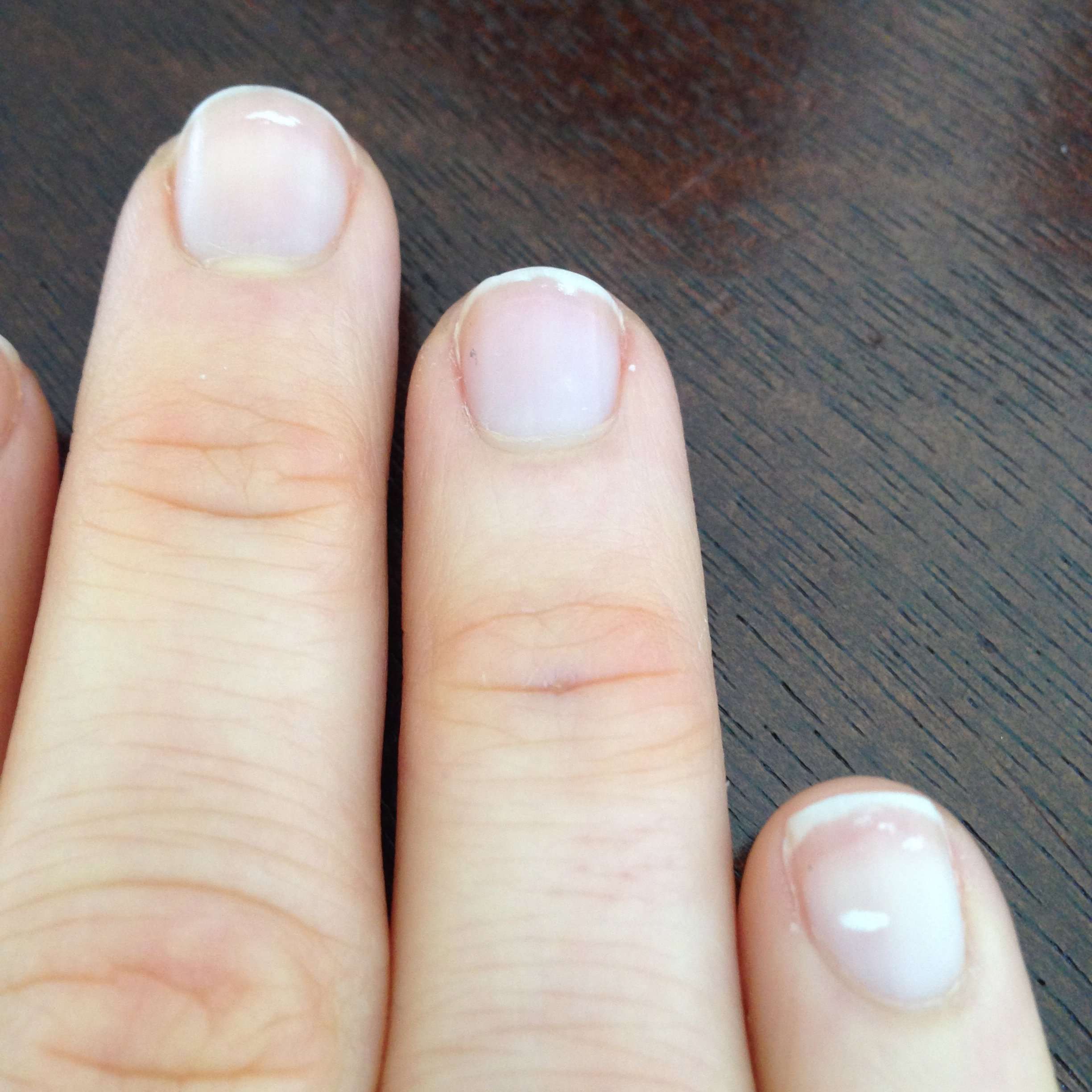 What do white spots on fingernails mean?