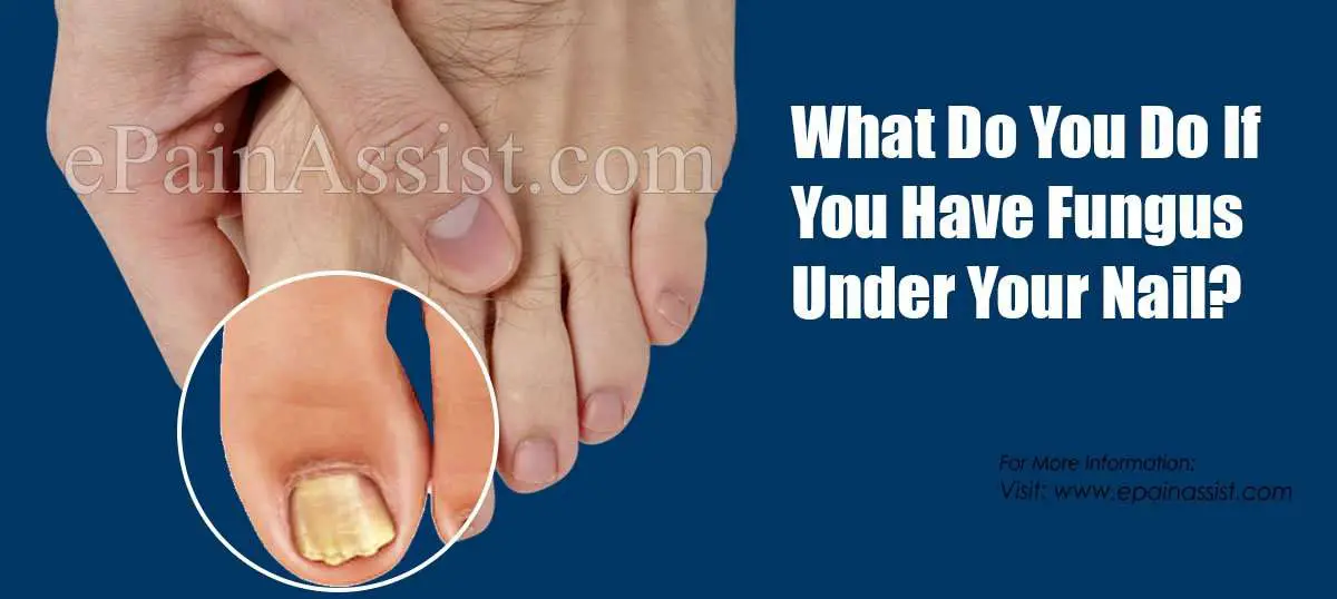 What Do You Do If You Have Fungus Under Your Nail?