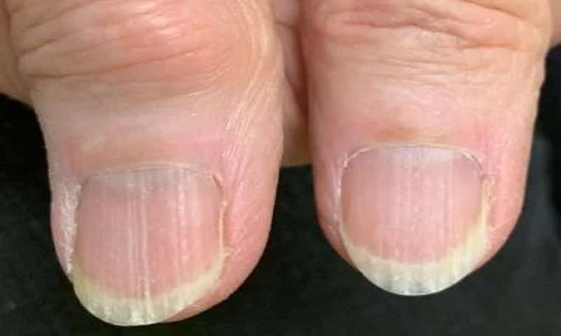 What do your Nails Say about your Health (6)