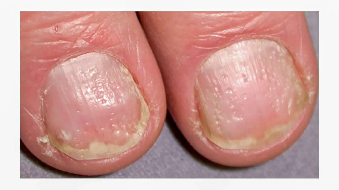 What Does Nail Psoriasis Look Like