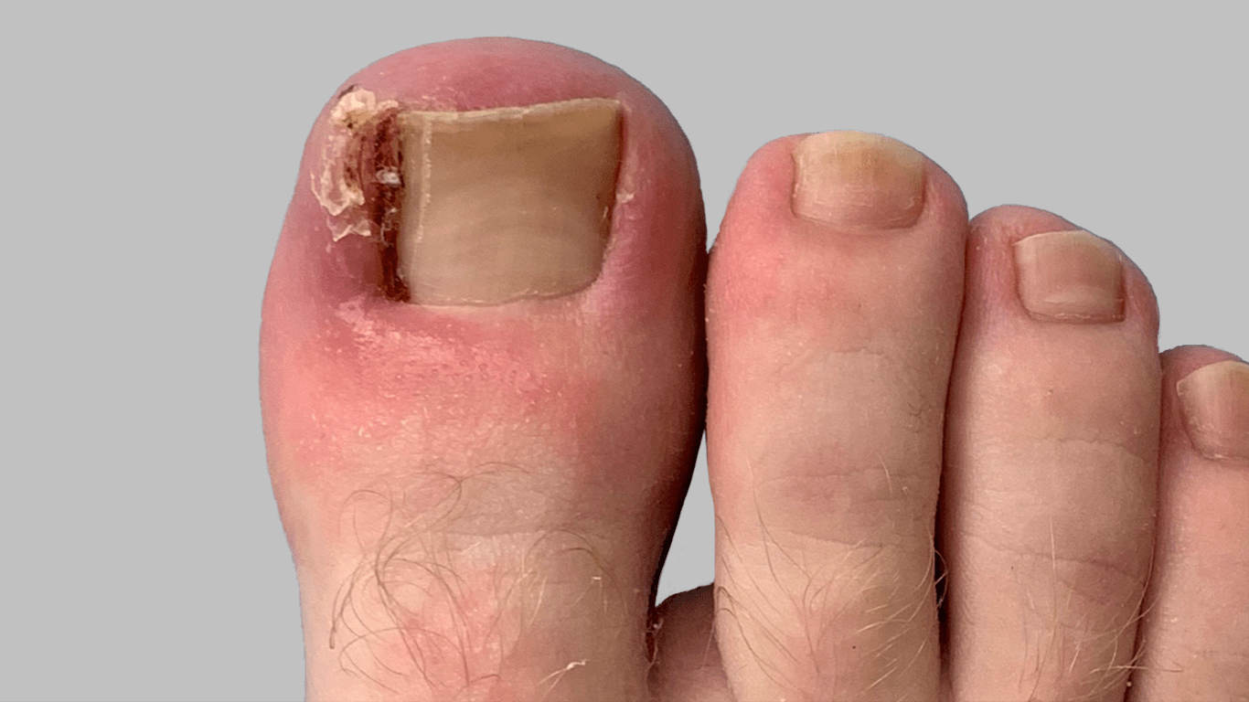 What to do for an ingrown toenail.