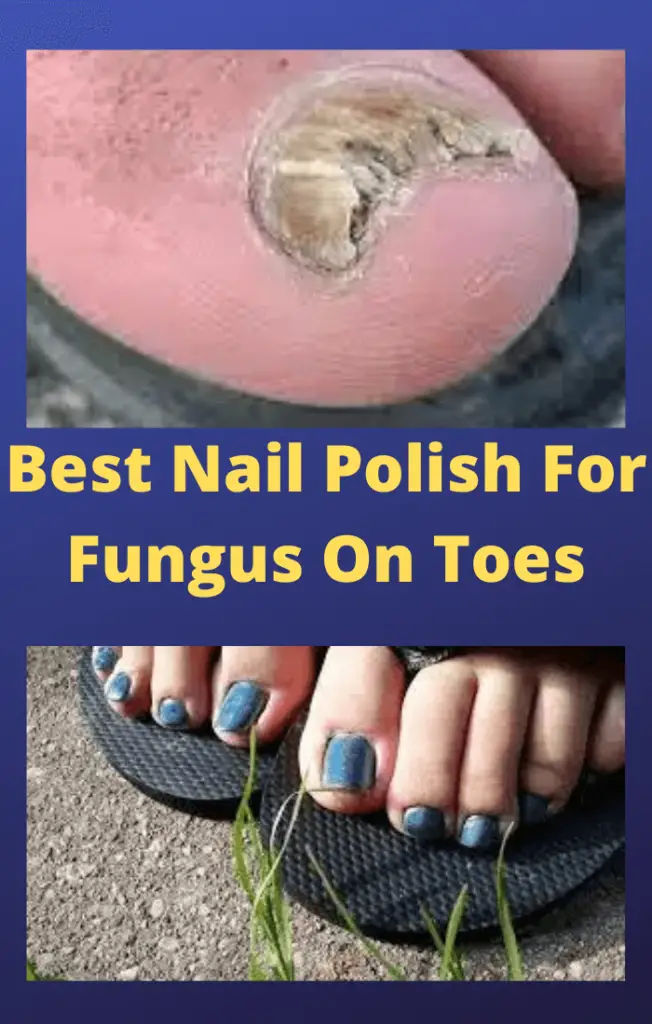 Whatâs The Best Nail Polish For Fungus On Toes